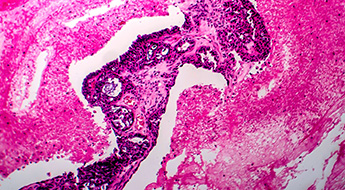 卵巣がんの新規検査項目HE4の院内測定による効果